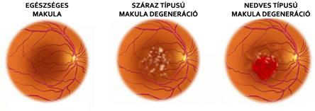 makula degenerációs látásvizsgálat homályos látás koleszterin